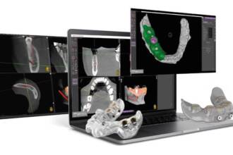 Implantologia computer guidata: spiegata semplice e senza tecnicismi