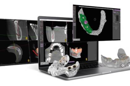Implantologia computer guidata: spiegata semplice e senza tecnicismi