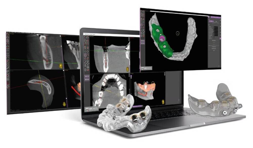 Implantologia computer guidata: spiegata semplice e senza tecnicismi Implantologia computer guidata: spiegata semplice e senza tecnicismi